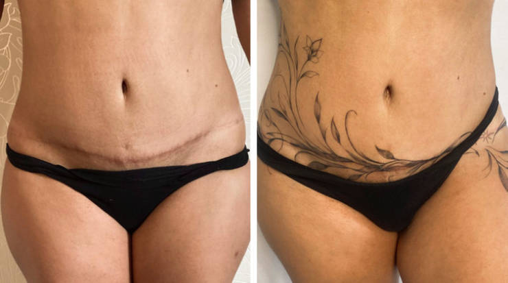 Artist Saves People’s Scars By Tattooing Over Them