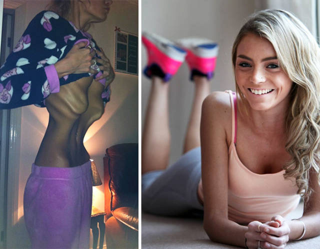 Anorexia Is Not The Final Verdict!