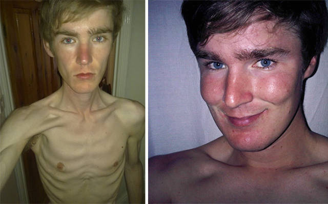 Anorexia Is Not The Final Verdict!