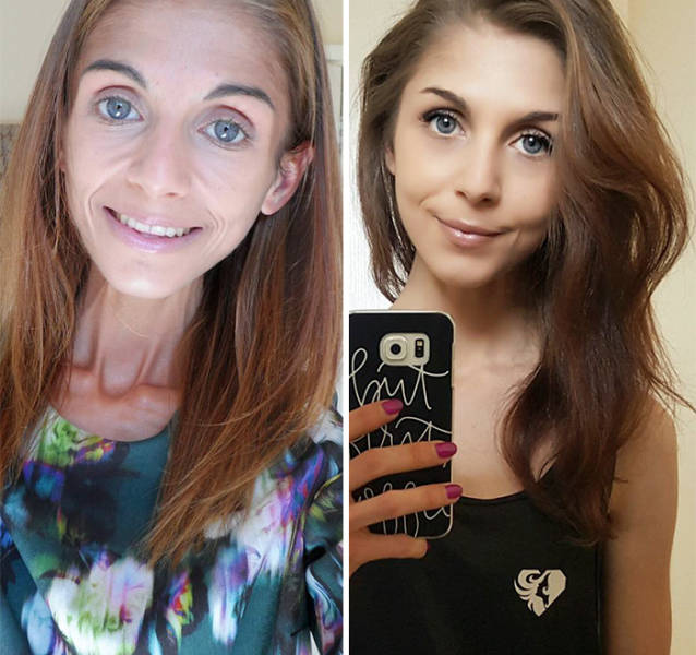 Anorexia Is Not The Final Verdict!