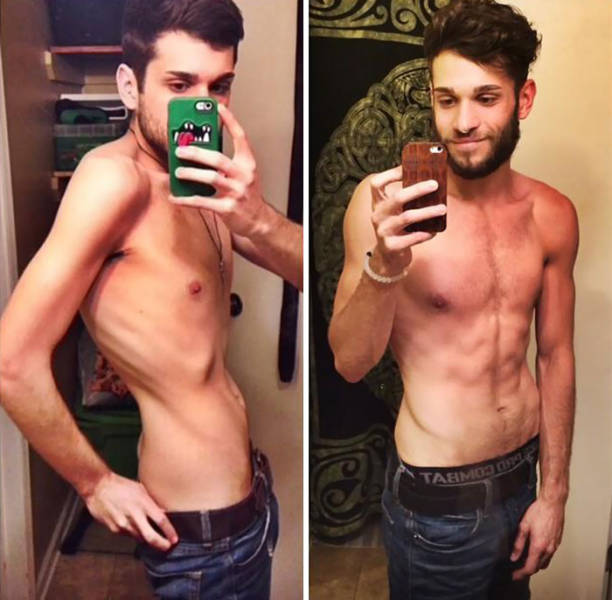 Anorexia Is Not The Final Verdict!