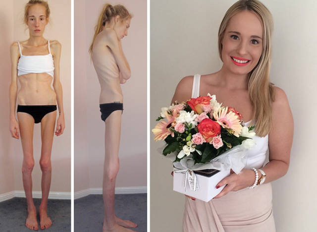 Anorexia Is Not The Final Verdict!
