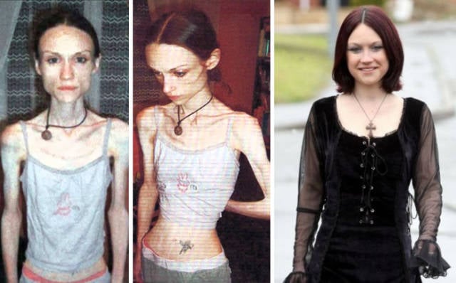 Anorexia Is Not The Final Verdict!
