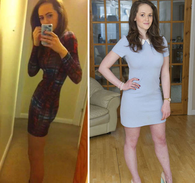Anorexia Is Not The Final Verdict!