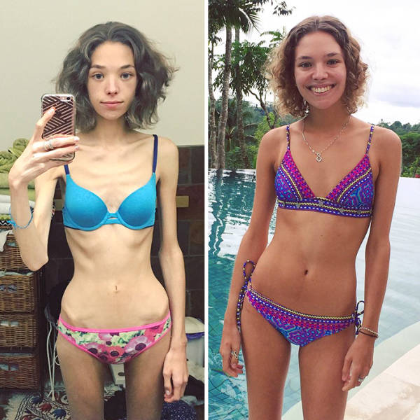 Anorexia Is Not The Final Verdict!