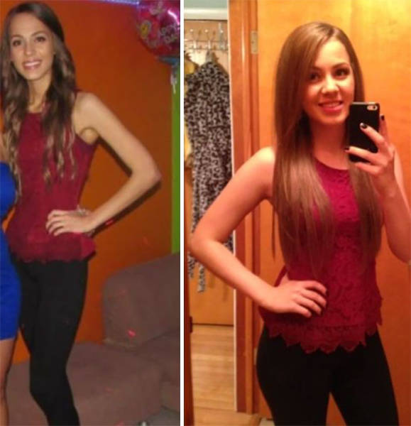 Anorexia Is Not The Final Verdict!