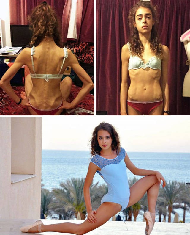 Anorexia Is Not The Final Verdict!