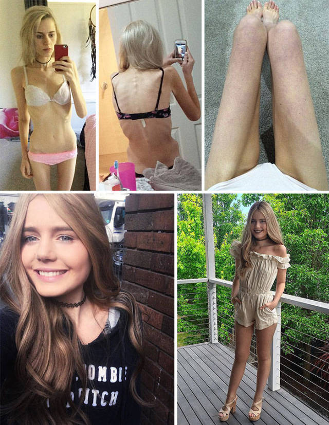 Anorexia Is Not The Final Verdict!