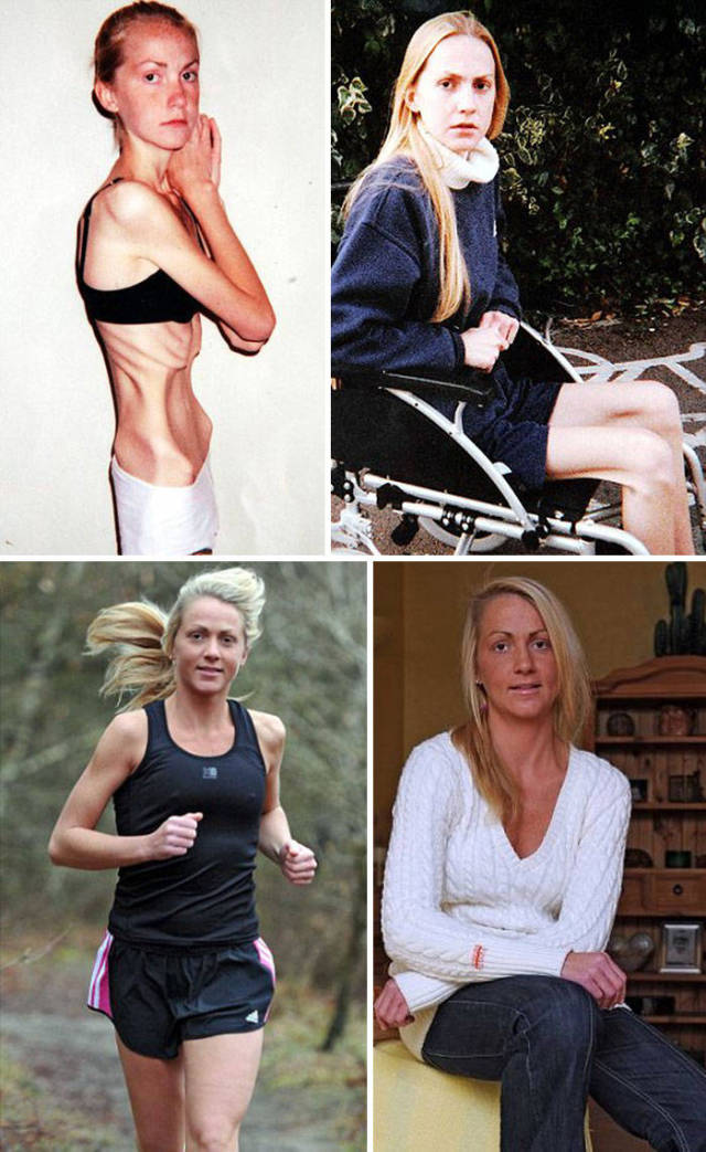 Anorexia Is Not The Final Verdict!