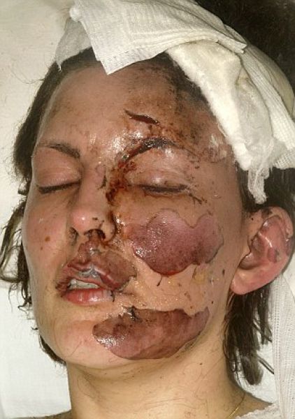 Incredible Healing after a Bomb Explosion (15 pics) Incredible Healing after a Bomb Explosion (15 pics)