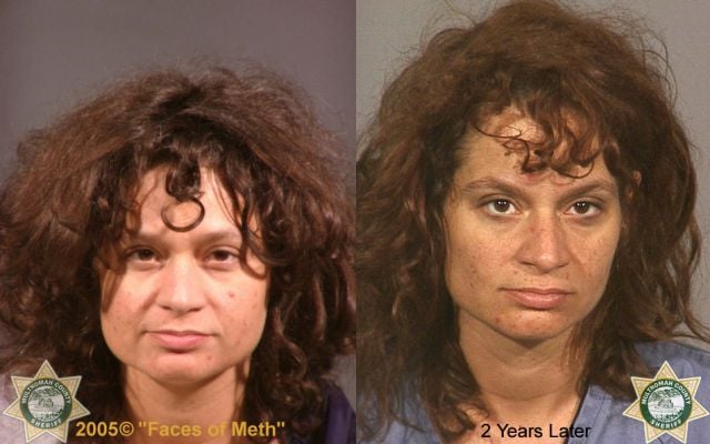 Meth Addicts: Before and After