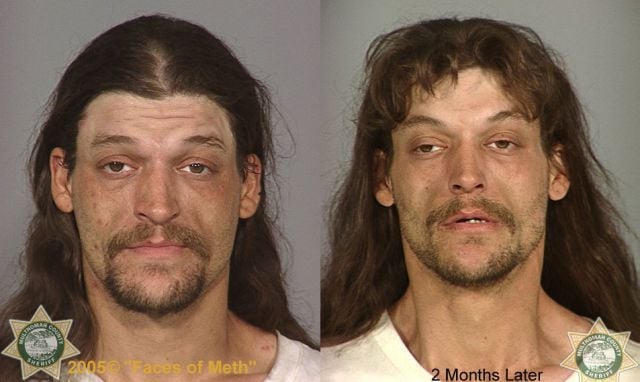 Meth Addicts: Before and After