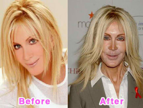 Celebrity Plastic Surgery Before & After