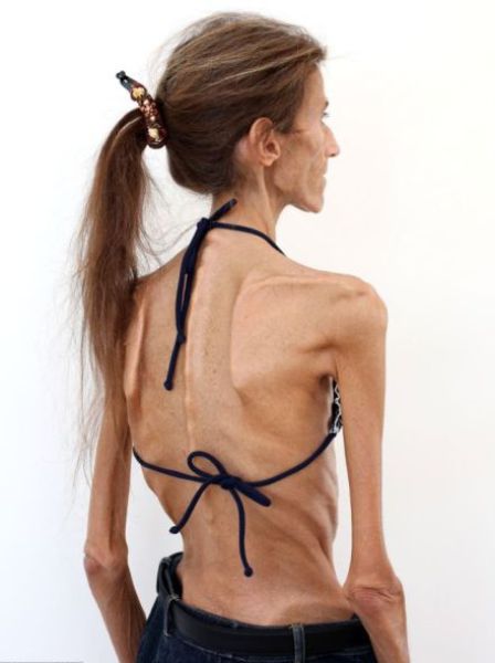 Her Dream Body Is Killing Her