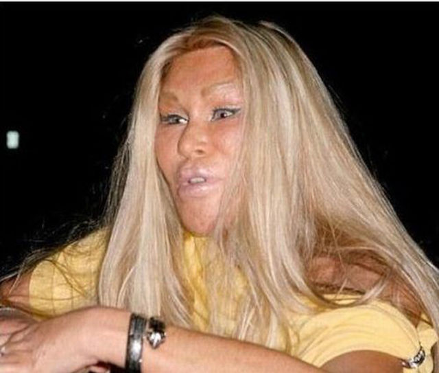 Plastic Surgery Fails That Are Just Wrong